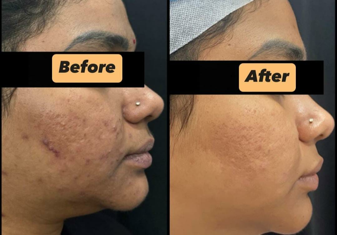 Laser Skin Tightening