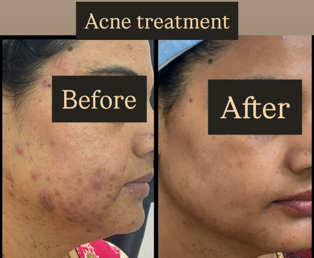 Laser Skin Tightening