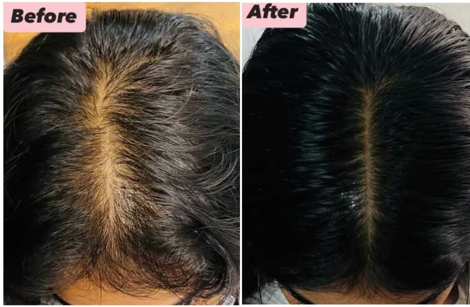 Laser Skin Tightening