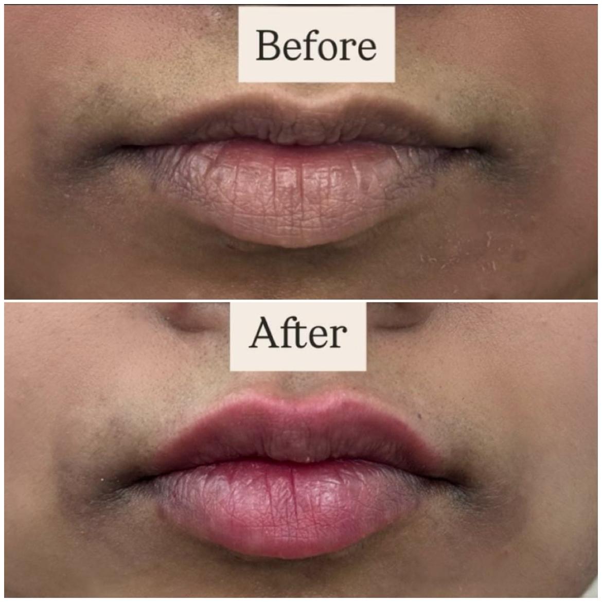Laser Hair Removal Image