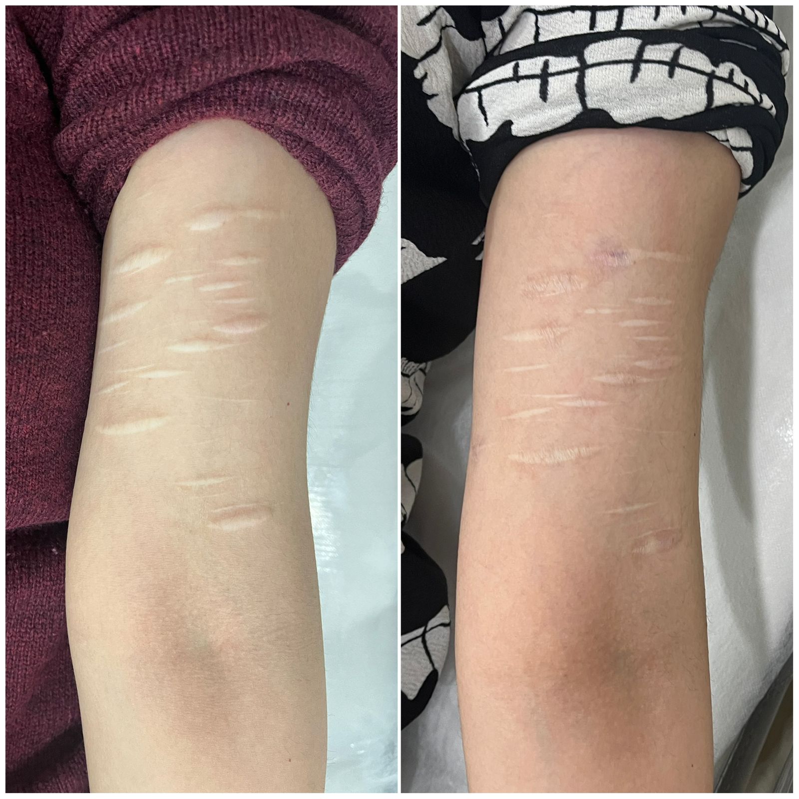 Laser Hair Removal Image