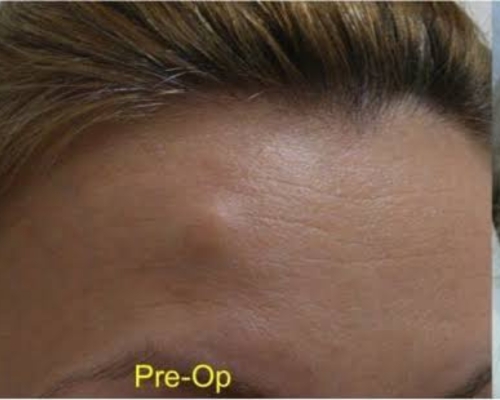 Laser Hair Removal Image
