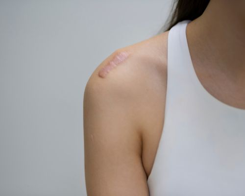 Laser Hair Removal Image