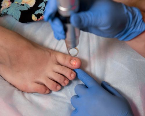 Laser Hair Removal Image