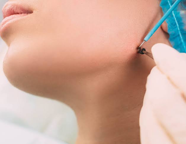 Laser Hair Removal Image