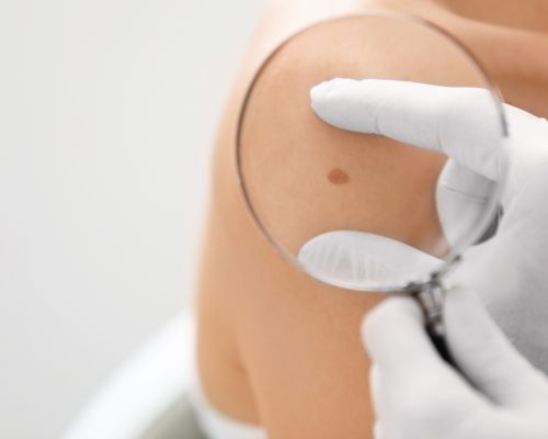 Laser Hair Removal Image