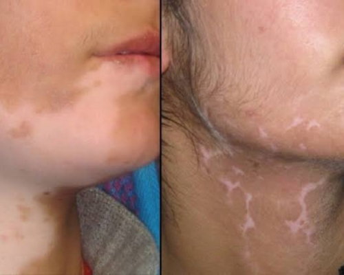 Laser Hair Removal Image