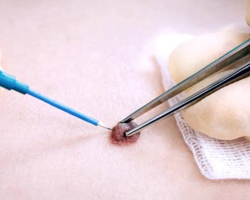 Laser Hair Removal Image