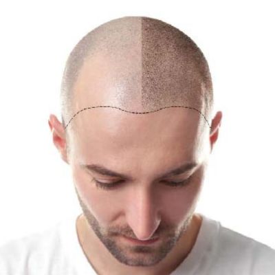 Image for Microdermabrasion Services