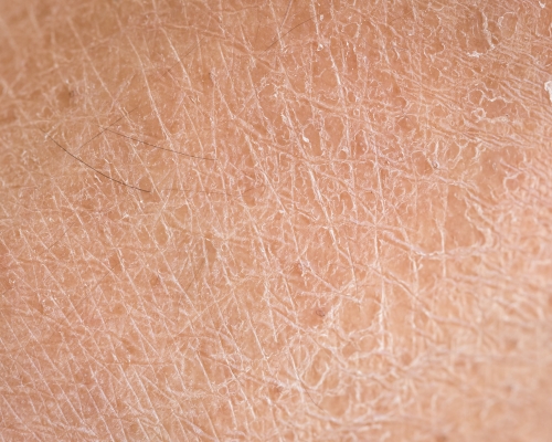 Laser Skin Tightening