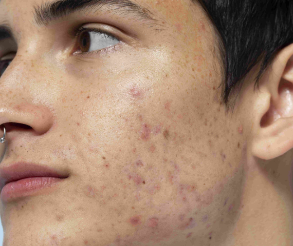 Laser Skin Tightening