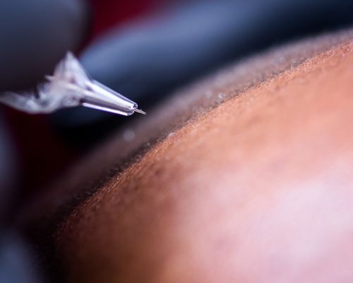 Laser Skin Tightening